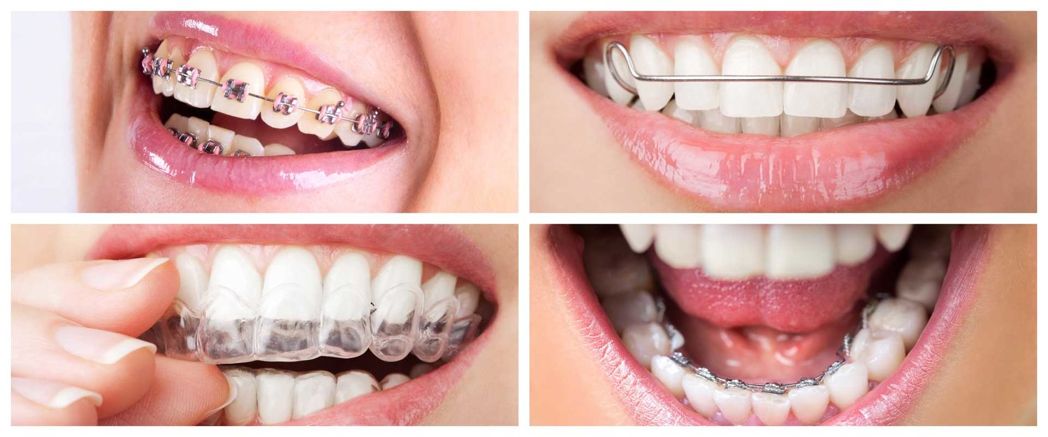 What are the different types of braces available to treat teeth